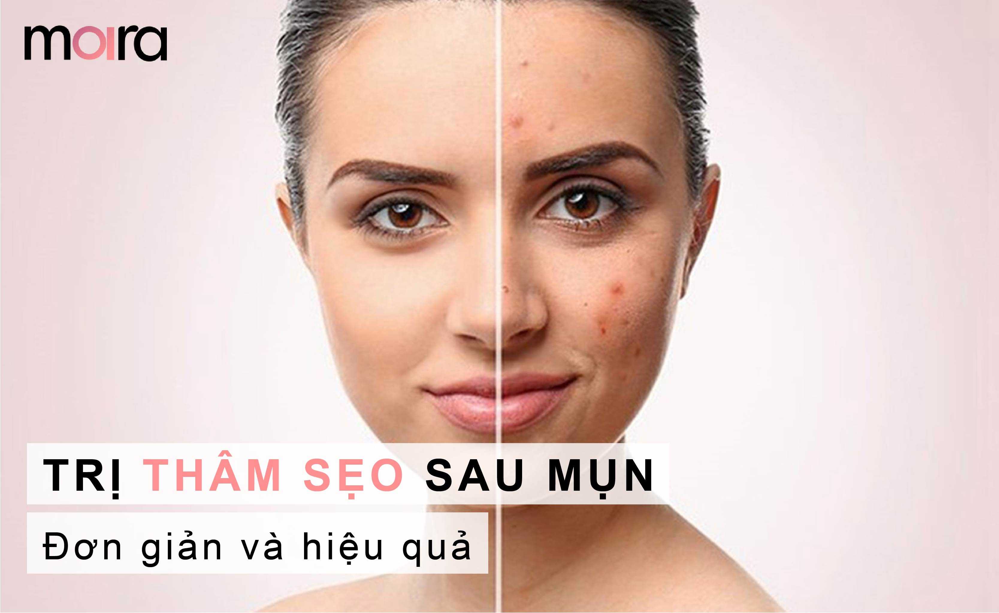 Hướng dẫn trị thâm sẹo sau mụn đơn giản và hiệu quả